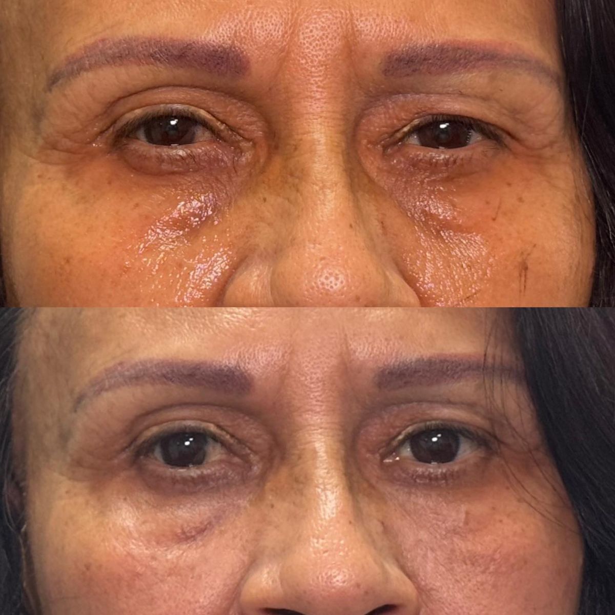 Skinbooster · Olheiras