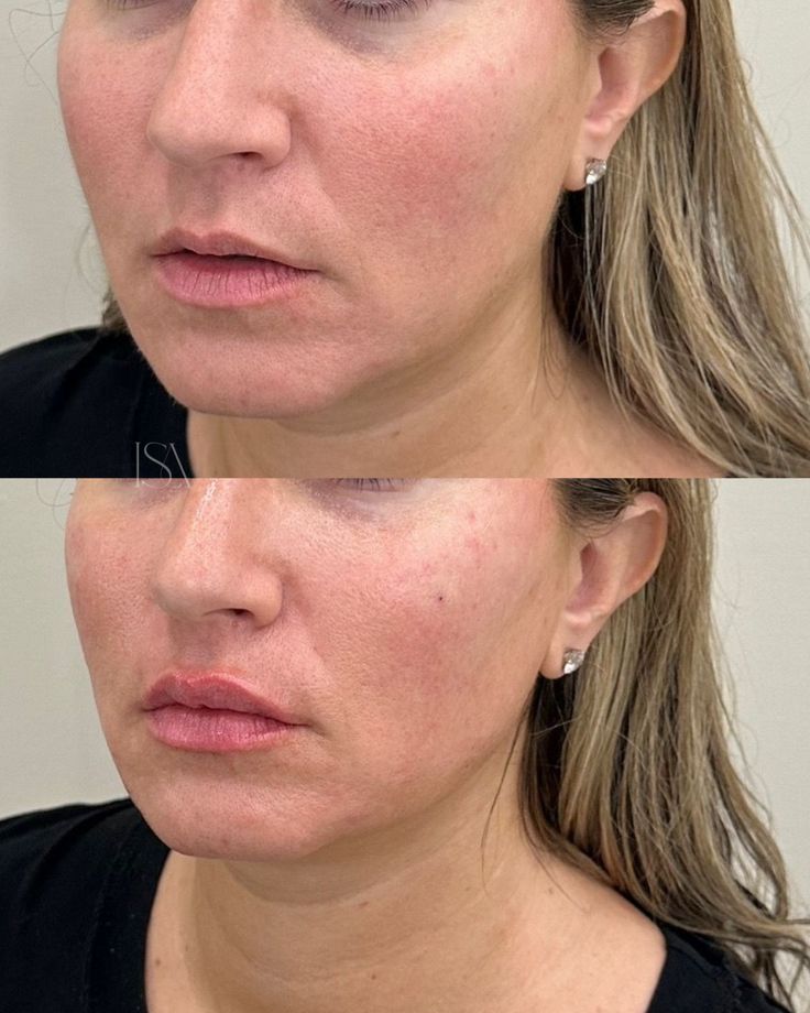 Preenchimento Facial
